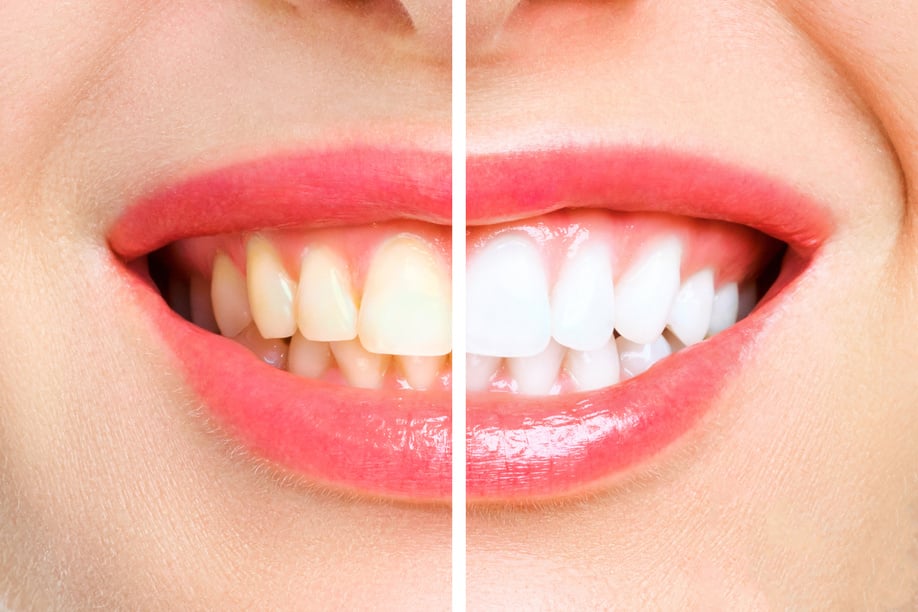 woman teeth before and after whitening. Over white background